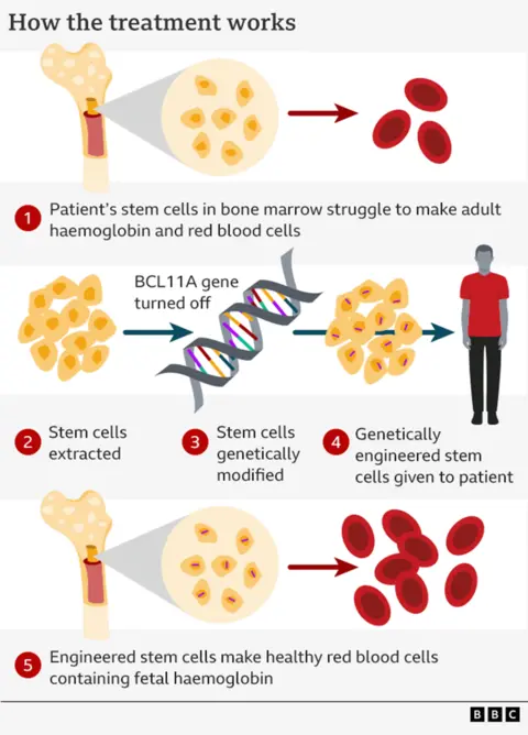 Graphic explaining the process of extracting bone marrow, editing it in the lab and putting it back into the patient