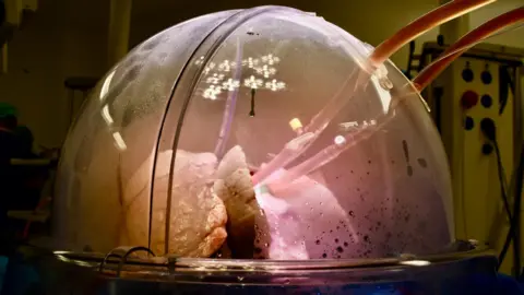 Royal Papworth Hospital Donated lungs inside a special dome shaped incubator. The dome is plastic and you can see the tubes carrying liquid oxygen and nitrates going into the trachea of the lungs. They are being inflated by a ventilator