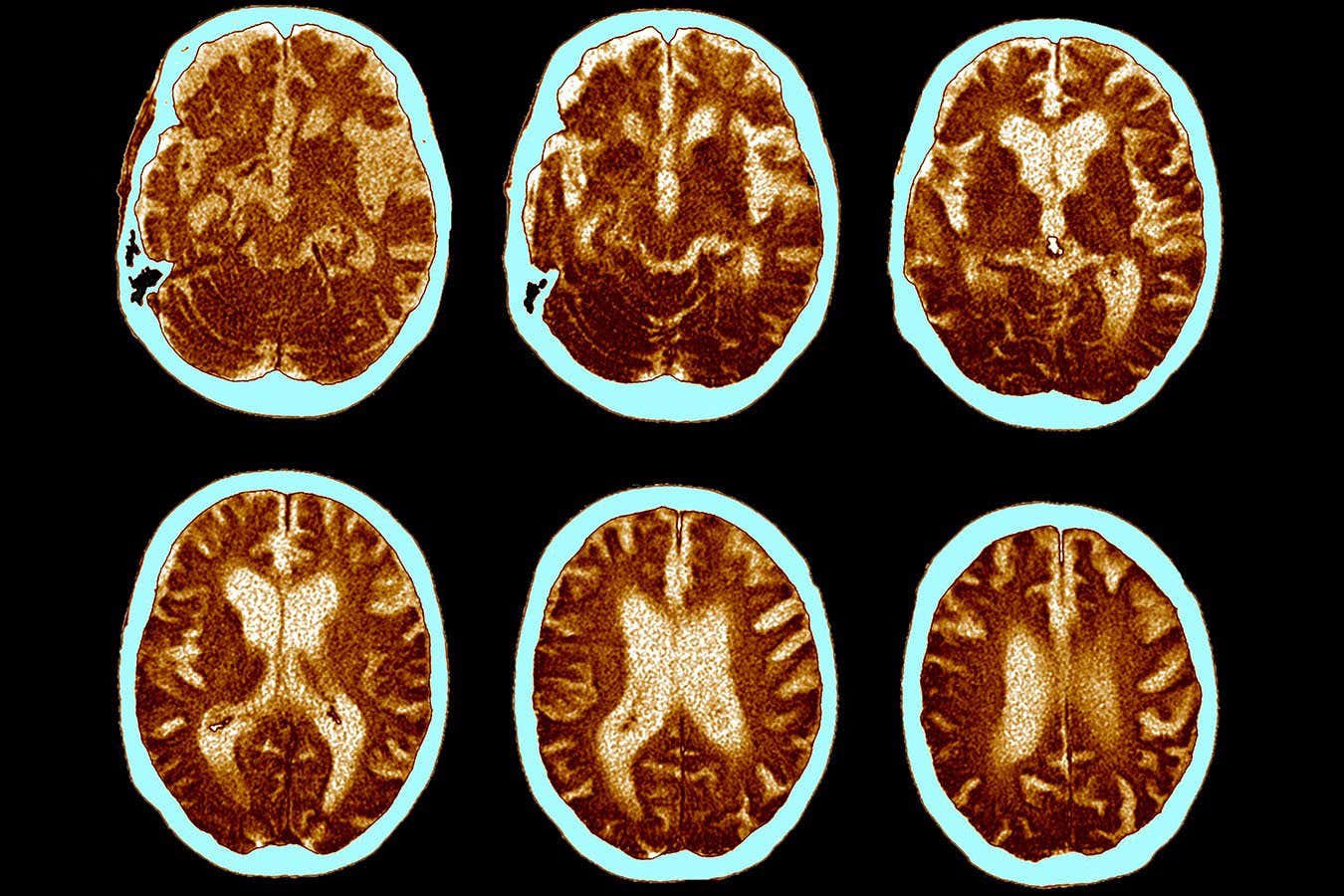 B6DT04 Alzheimers disease. Series of computed tomography (CT) scans of an axial section through the head of a 74-year-old patient.