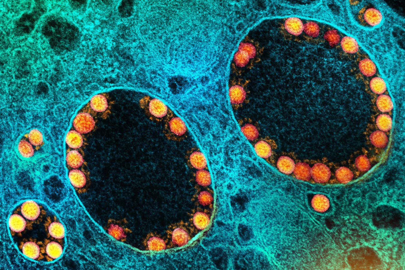 Transmission electron micrograph of SARS-CoV-2 virus particles (gold) within a nasal cell