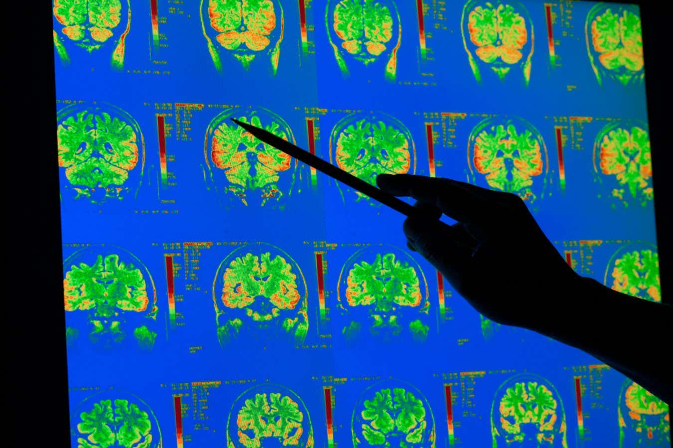 MRI brain scans