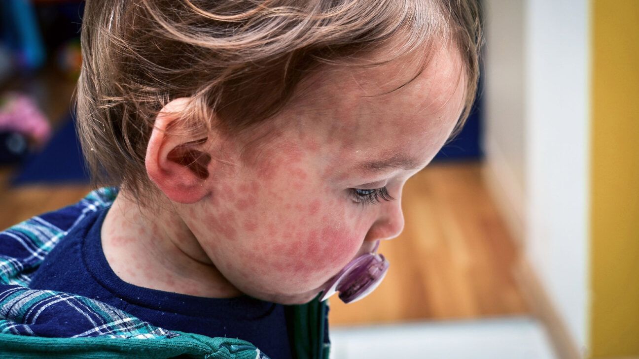 Young child with measles