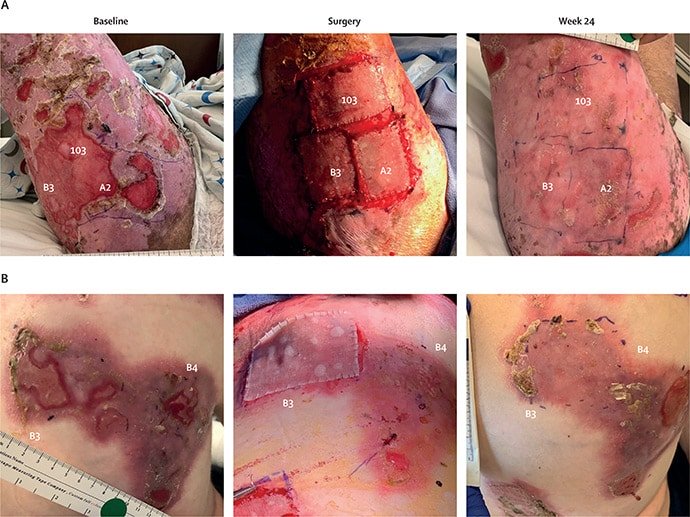 photo of Images of wounds randomly assigned to prademagene zamikeracel or control at baseline, surgery, and week 24.