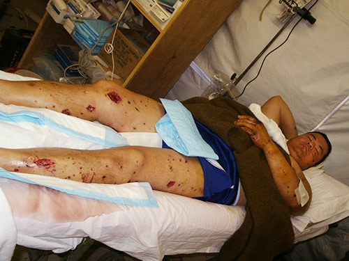 photo of Dr. Lee's shrapnel injuries were extensive.