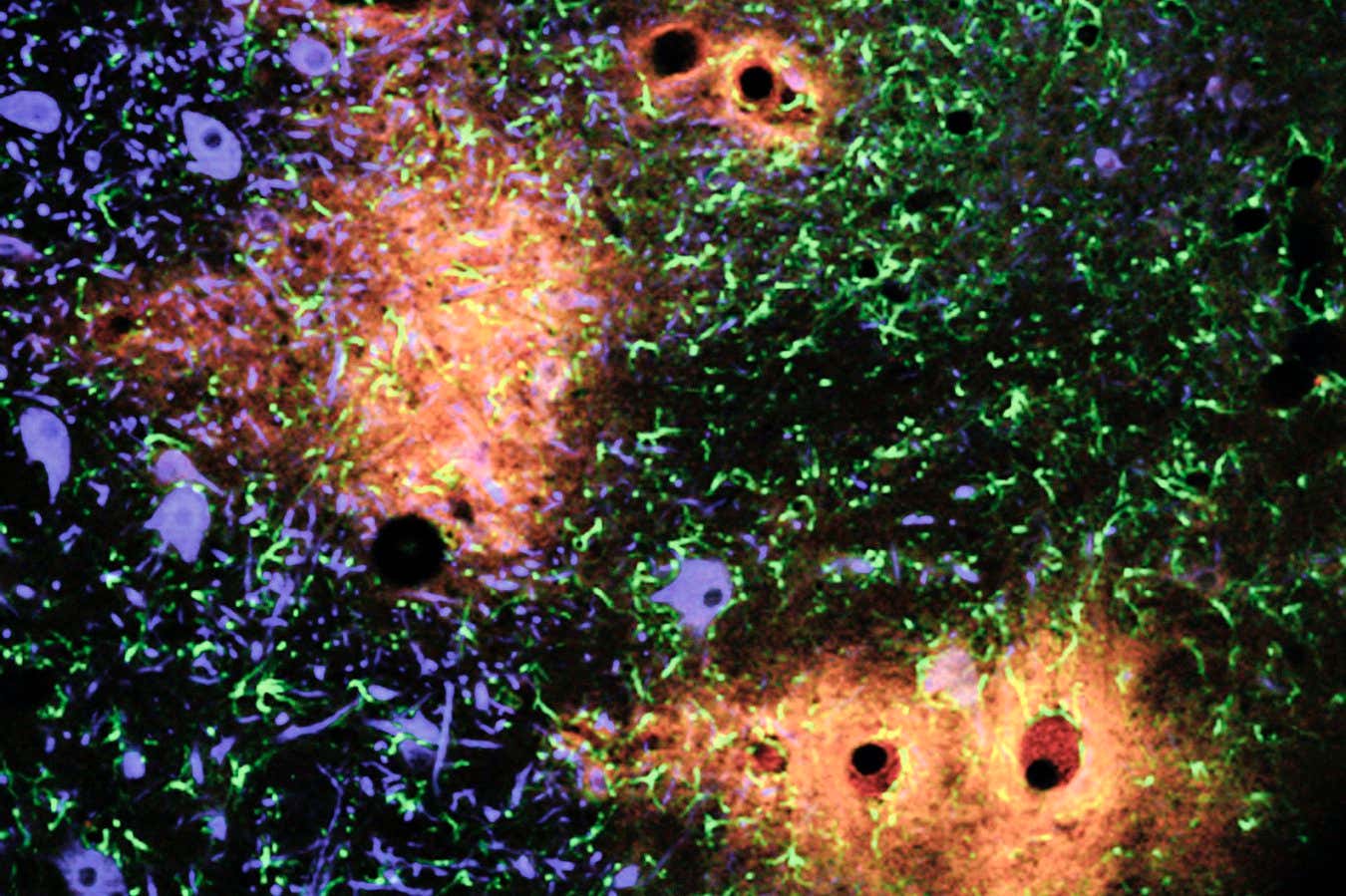 A slice of brain tissue under the microscope shows blood-brain barrier breakdown and leakage to surrounding area