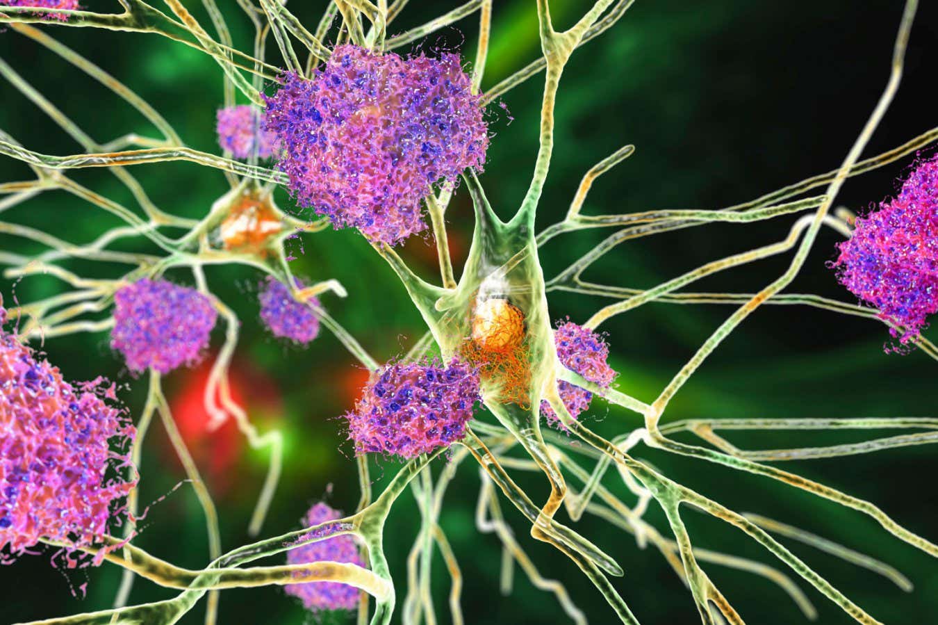 2G2HC45 Nerve cells affected by Alzheimer's disease, illustration