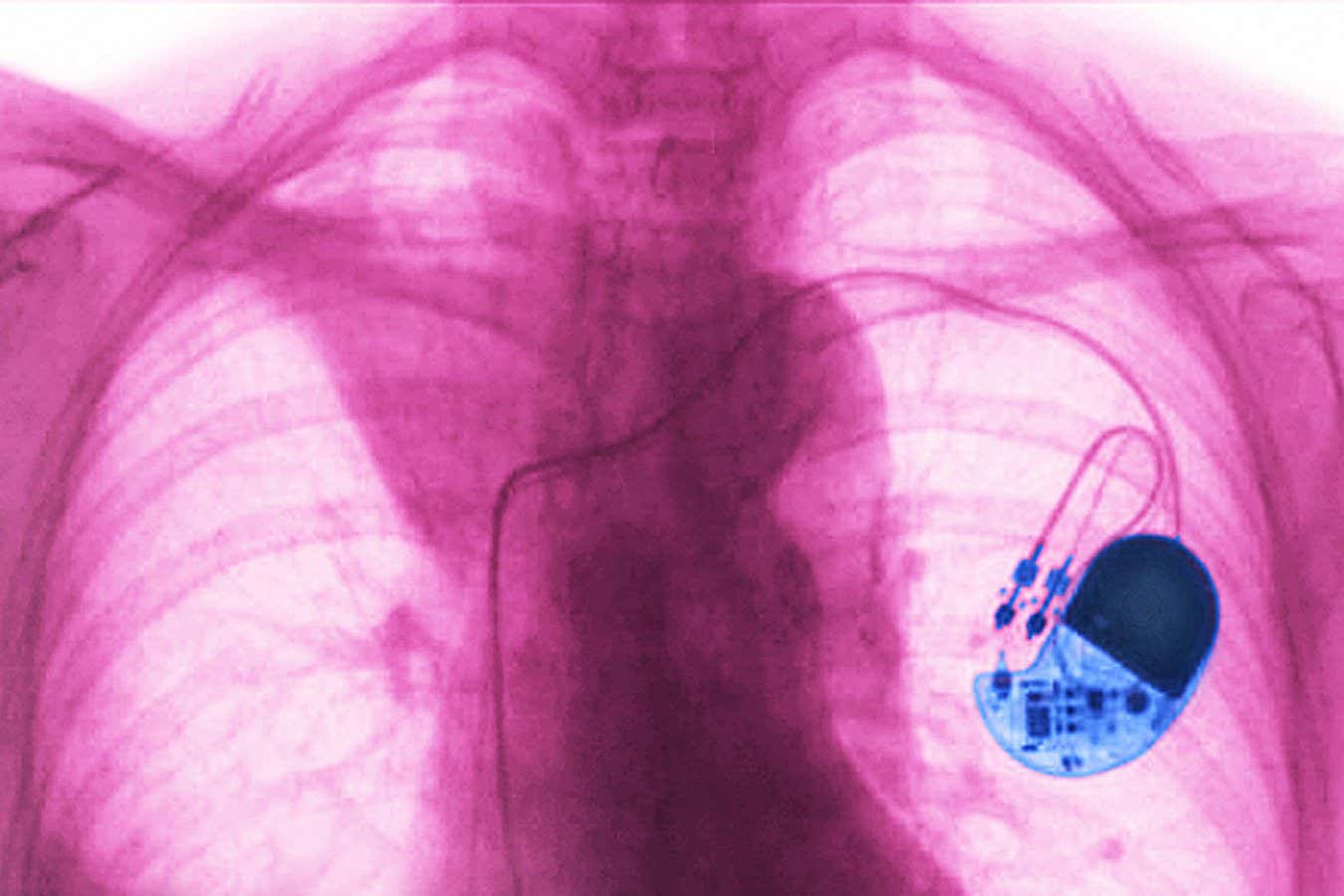 A frontal chest x-ray of a pacemaker.