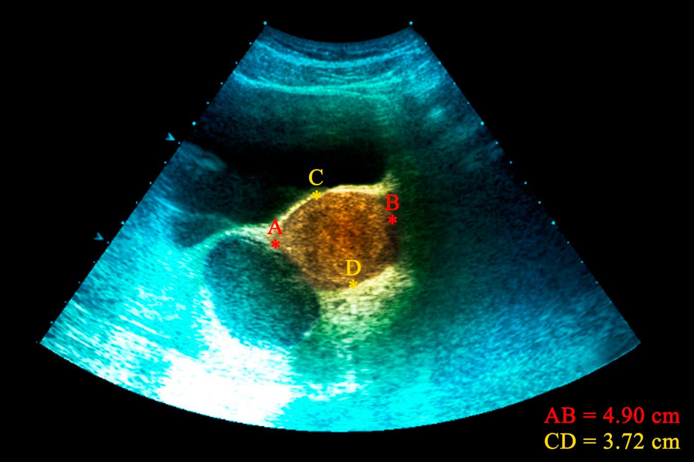Endometrioid cyst. Coloured ultrasound scan of a cyst (orange) caused by endometriosis in the right ovary of a 34-year-old woman. Endometriosis is a condition where tissue from the inner lining of the uterus (endometrium) is found elsewhere in the pelvic cavity. If the tissue forms a well-defined mass, as seen here, it is called an endometrioma. The ovaries are the most commonly affected site. Ultrasound scanning is a diagnostic technique that uses high-frequency sound waves.