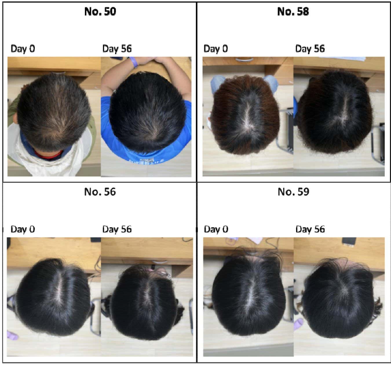 The improvement in hair growth among different participants in group five after 56 days of using the serum