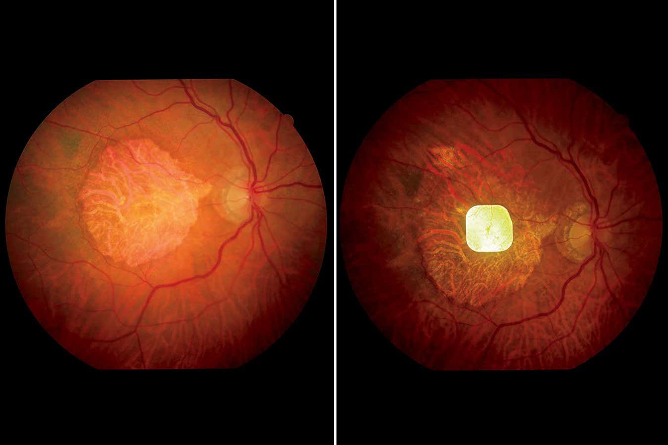A trial participant's eye without (left) and with the retinal implant (right)