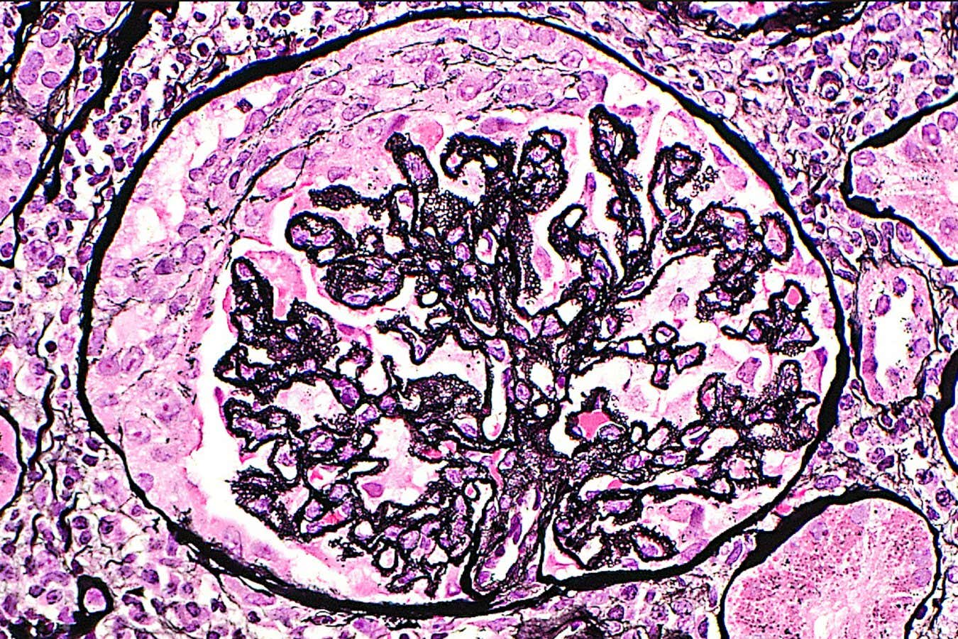 Light micrograph of membranous and crescentic lupus nephritis. In patients with lupus, the kidneys may be affected. In this kidney glomerulus, tiny white holes in the glomerular basement membrane (black) indicate membranous type of disease. There is also a crescent within this glomerulus (collection of pink cells) indicating activity of the lupus disease in the kidney. Jones silver stained tissue section. Magnification: 200x when printed at 10 centimetres.