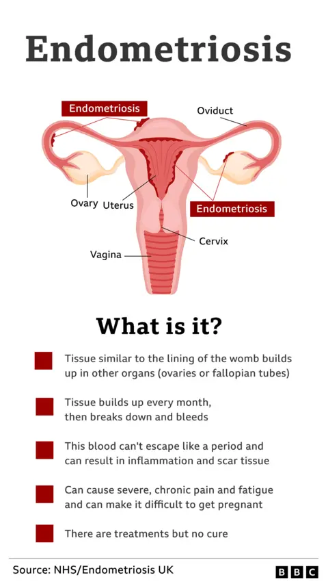 Endometriosis graphic showing a picture of a woman's anatomy, with the oviduct, ovaries, uterus, cervix and vagina marked, as well as where the endometriosis grows.