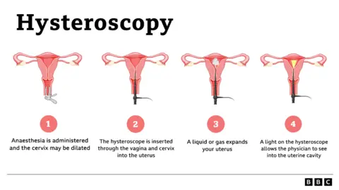 Graphic describing the hysteroscopy process from anaesthesia being administered to the camera being inserted through the vagina and cervix into the uterus to a liquid expanding the uterus to a light allowing the physician to see the uterine cavity.