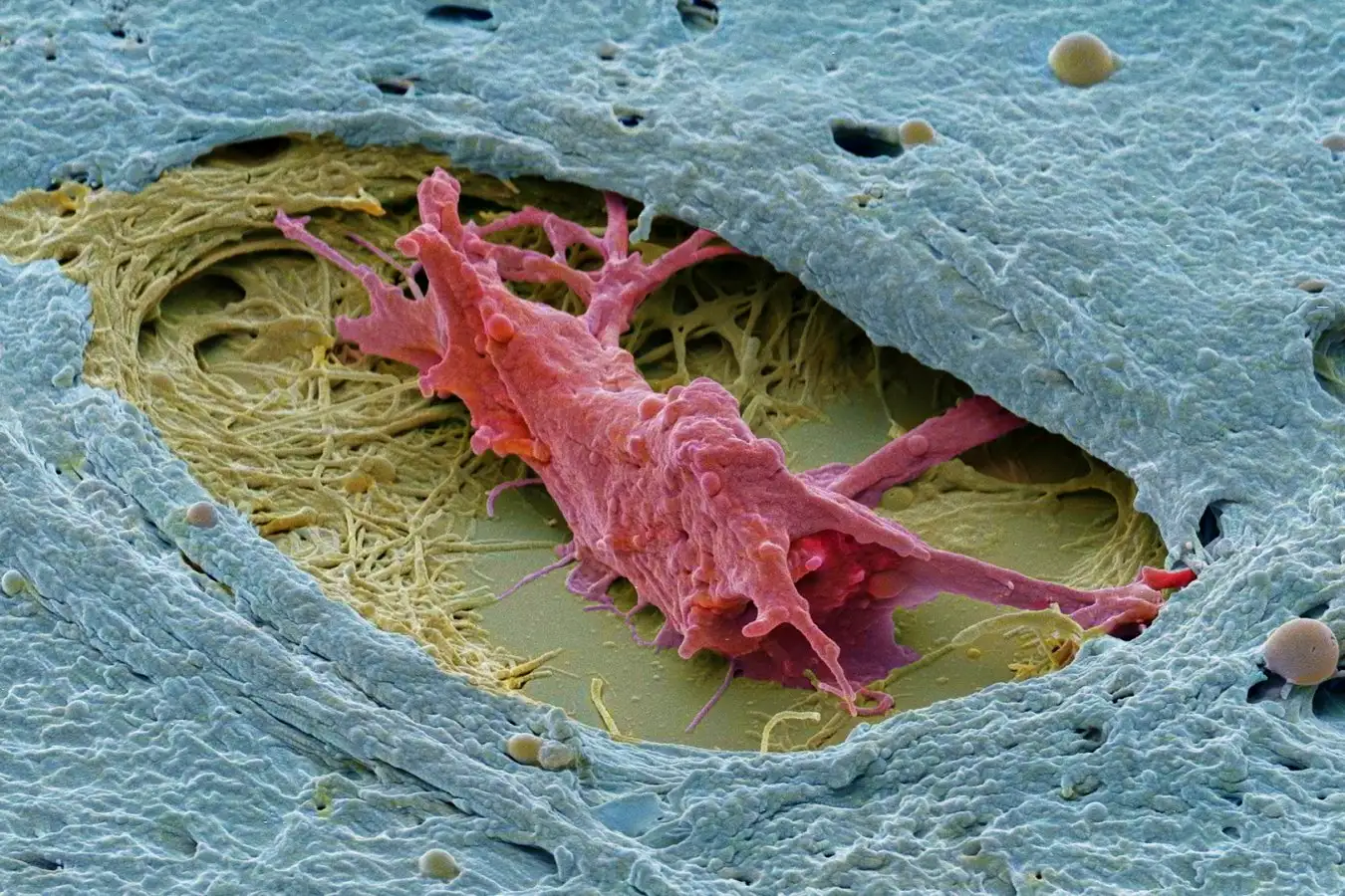 A scanning electron micrograph of a tumour. At the centre, you see a pink mass (an osteoclast), embedded in a larger ovarian teratoma (blue and yellow)