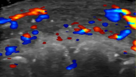 Rosa Maria Silveira Sigrist, M.D., and RSNA The ultrasound scan shows absent blood flow (the black areas) in a segment of an artery of the lip. Red shows blood flow towards the ultrasound probe, while blue shows flow away from it. 