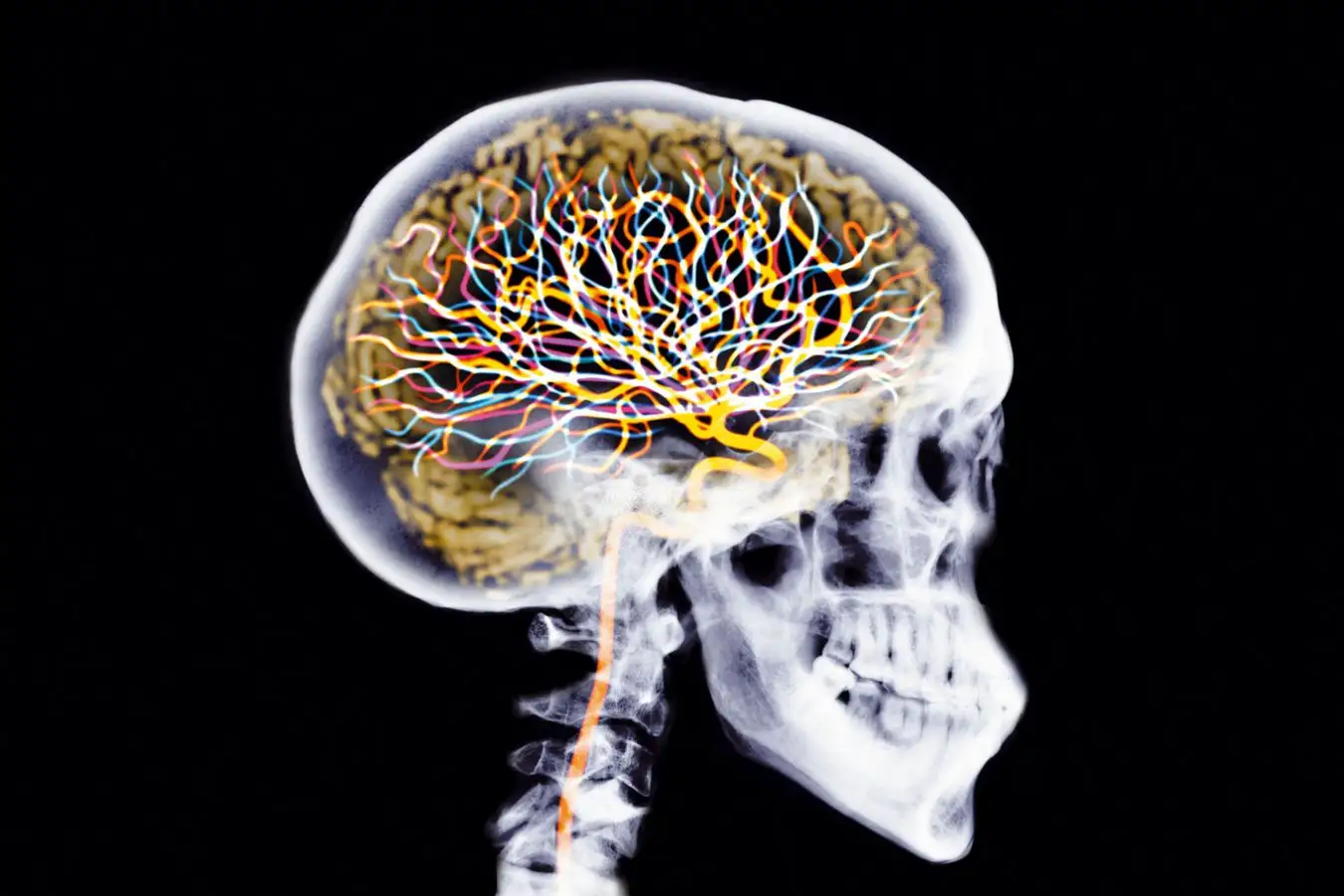 An X-ray skull with coloured brain and neurons