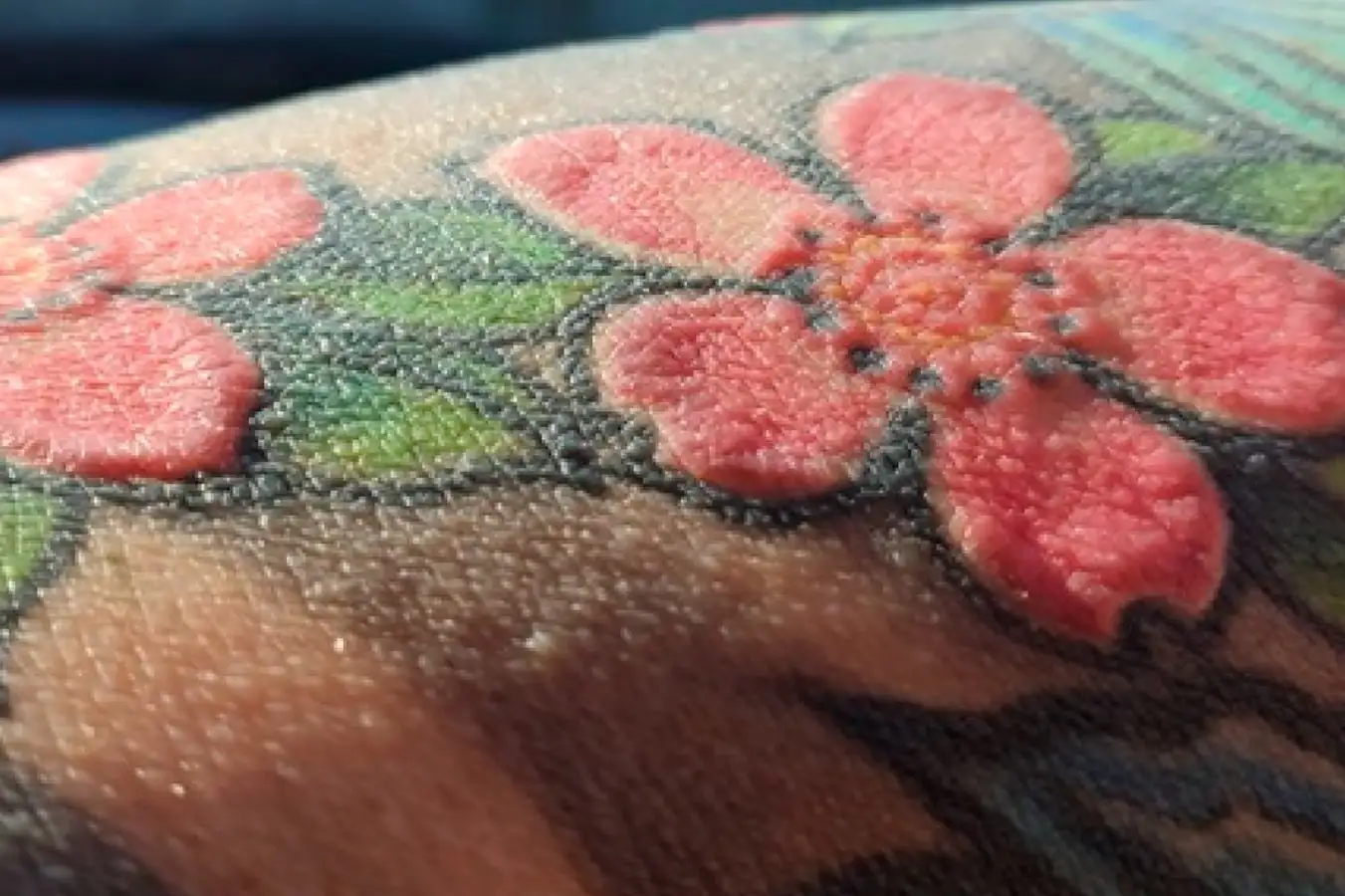 The inflamed parts of the man's tattoo containing red ink