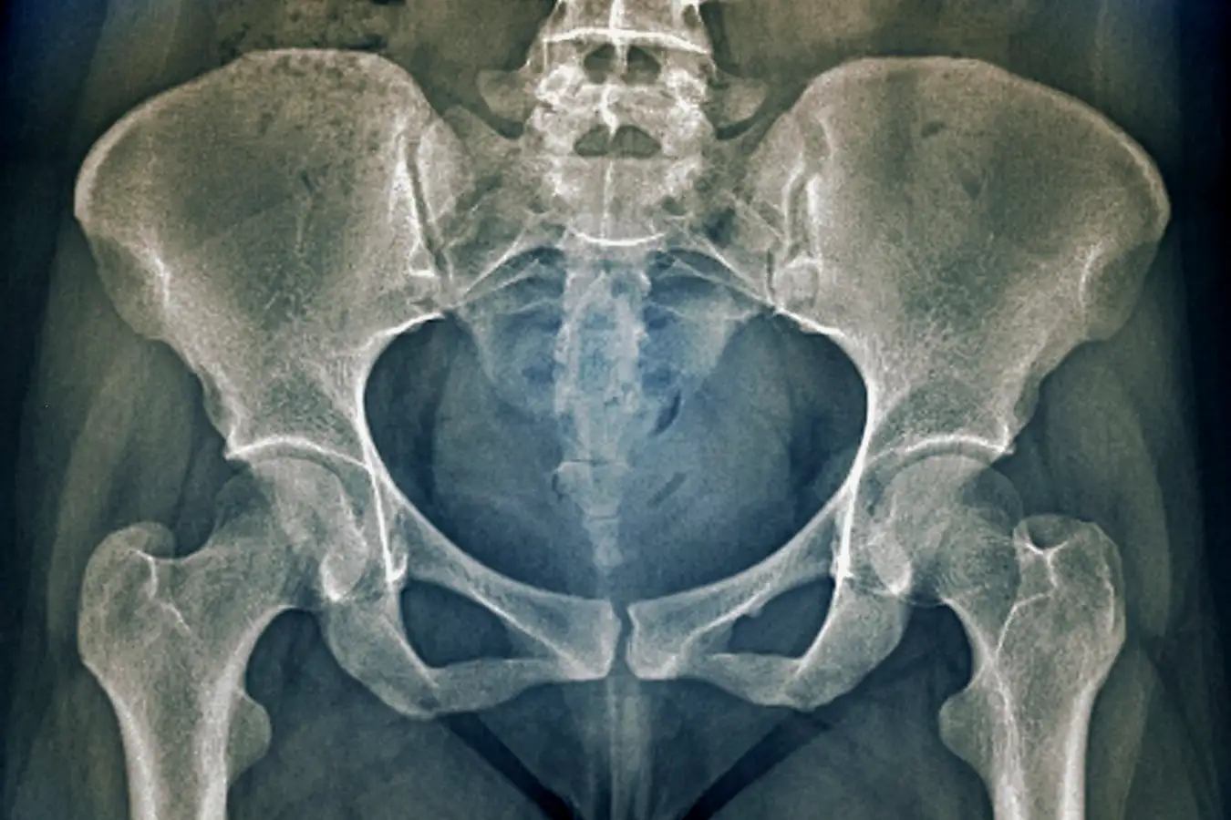 Female pelvis bones and joints. Coloured frontal X-ray of the bones and joints of the pelvis of a 21-year-old woman. The bones of the pelvis articulate with the femur bones to form the hip joints. The rear of the pelvis is formed of the sacrum and the coccyx, the lower parts of the vertebral column (backbone). The dark areas and shadows on the X-ray indicate the presence of various soft tissues of the abdomen, groin and leg, including the intestines.
