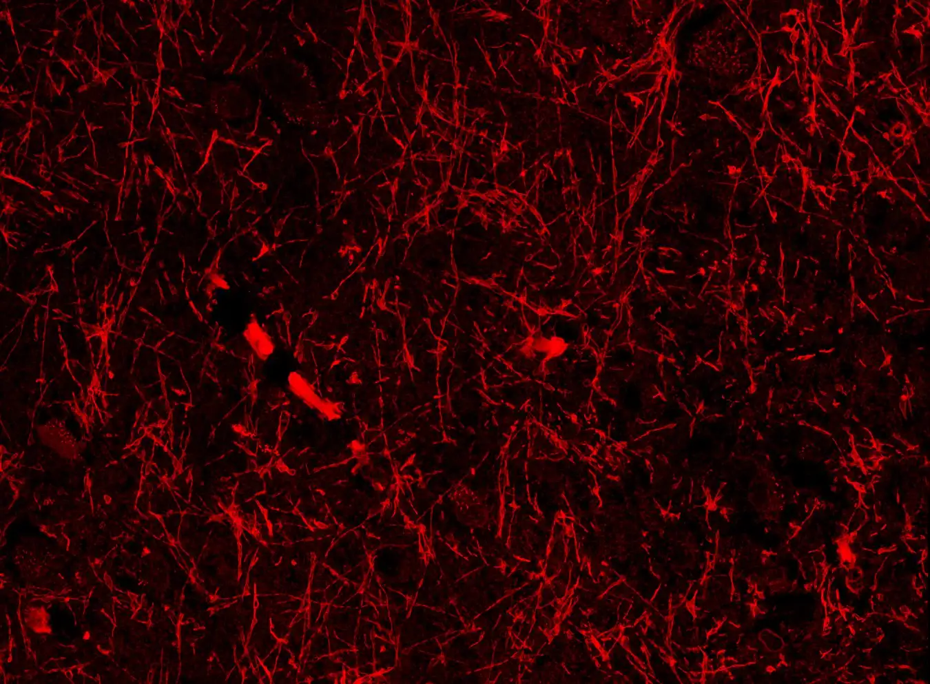 Lymphatic-like structures within the brain of a healthy person