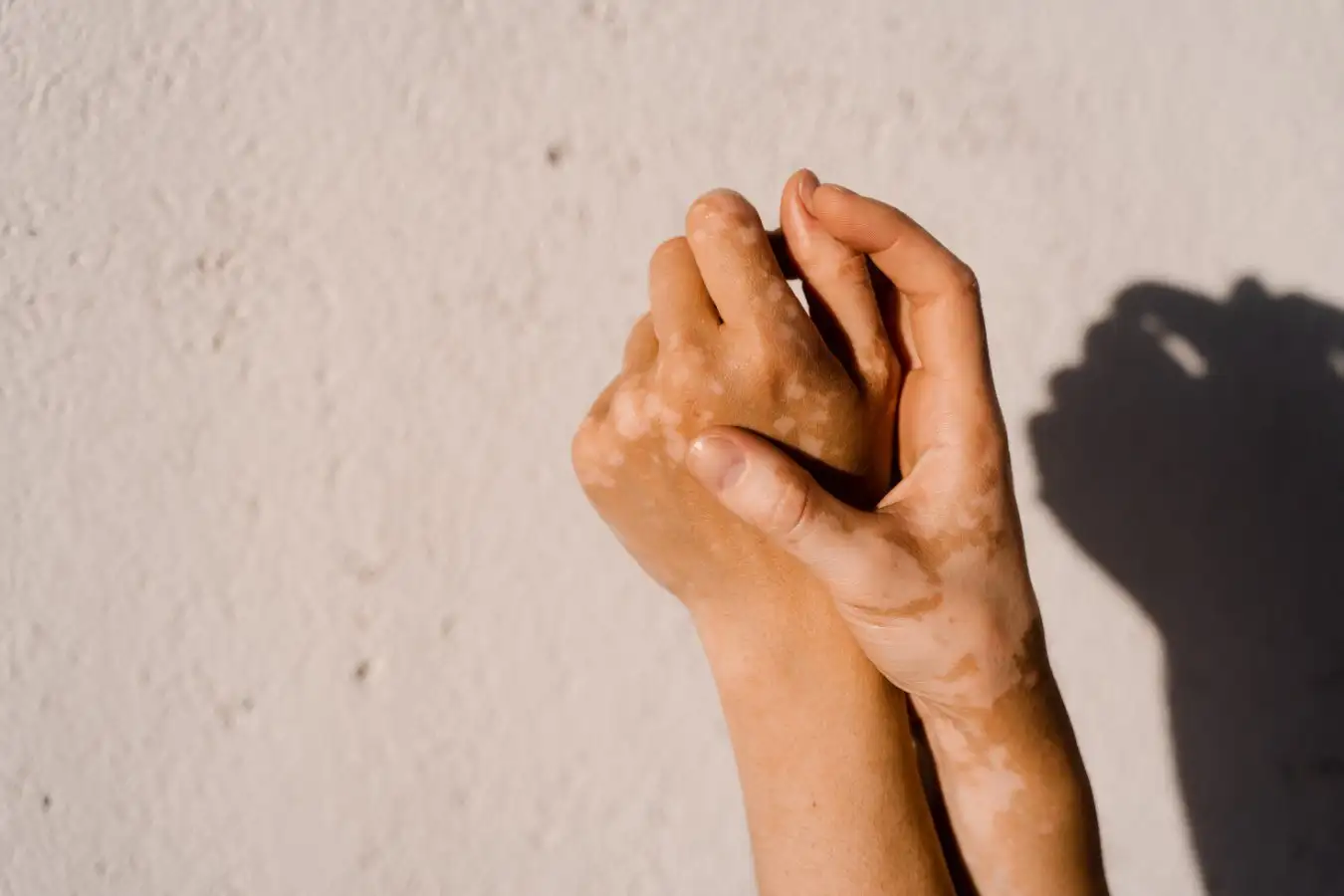Vitiligo skin pigmentation on the hands of woman