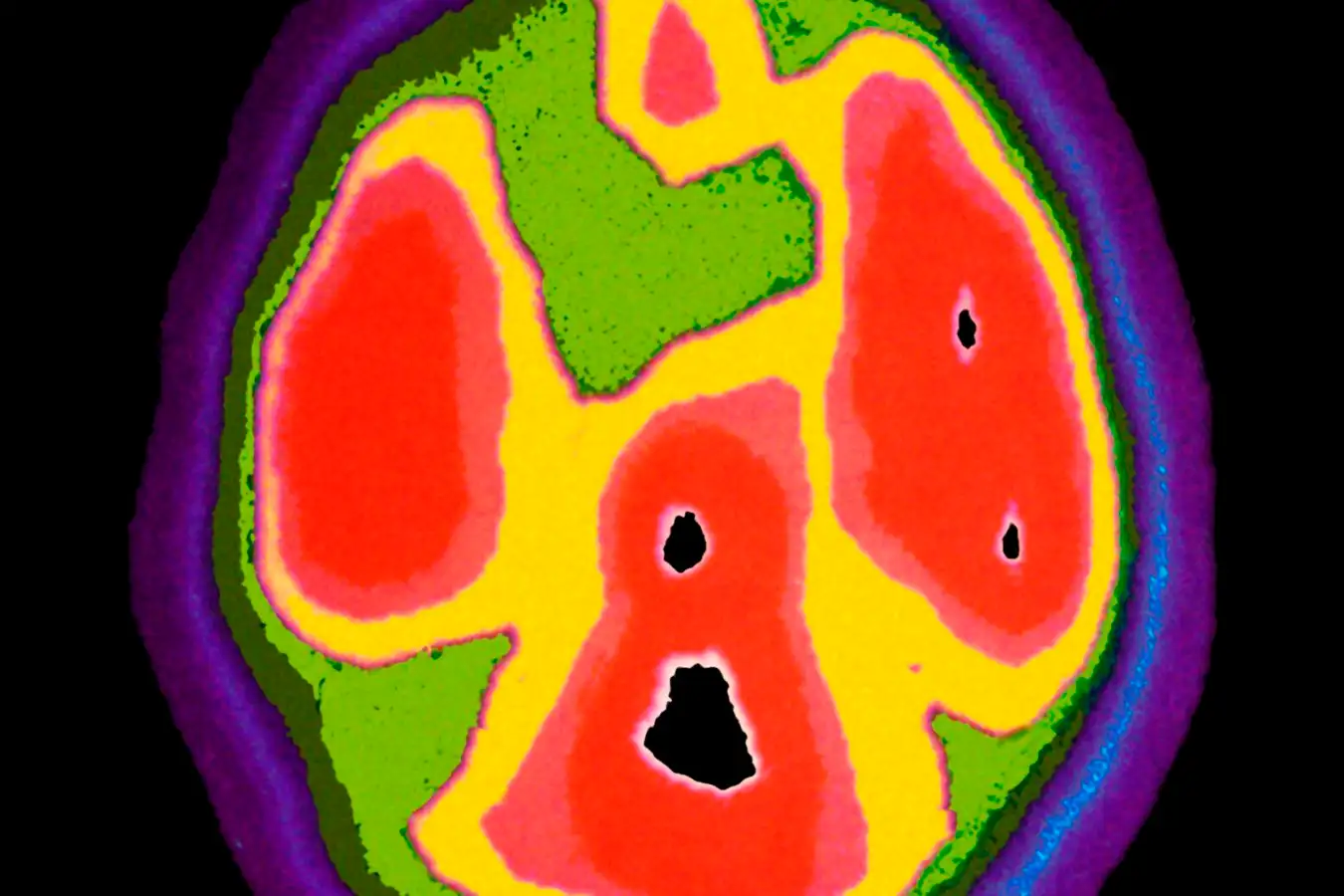 PET scan of the brain of a 4 year old with autism.