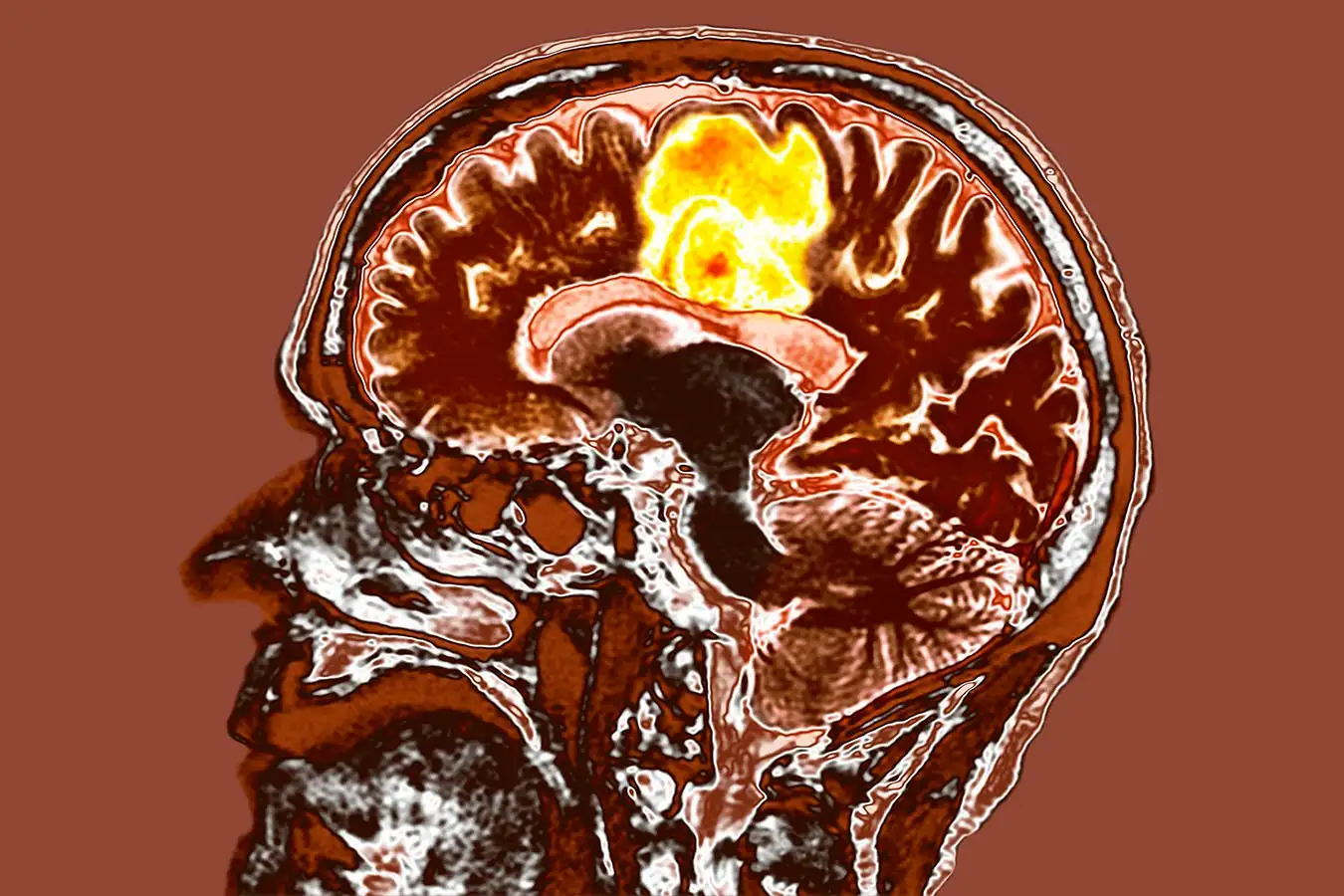 Glioblastoma brain cancer. Coloured computed tomography (CT) scan of a section through the brain of an 84-year-old female patient with glioblastoma (yellow, top). Glioblastoma is the most aggressive form of brain cancer. Treatment involves surgery, after which chemotherapy and radiation therapy are used. However, the cancer usually reoccurs despite treatment and the most common length of survival after diagnosis is 12-15 months. Without treatment, survival is typically 3 months.