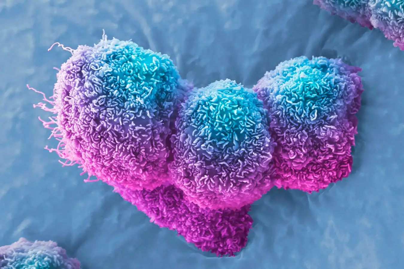 A scanning electron micrograph of pancreatic cancer cells