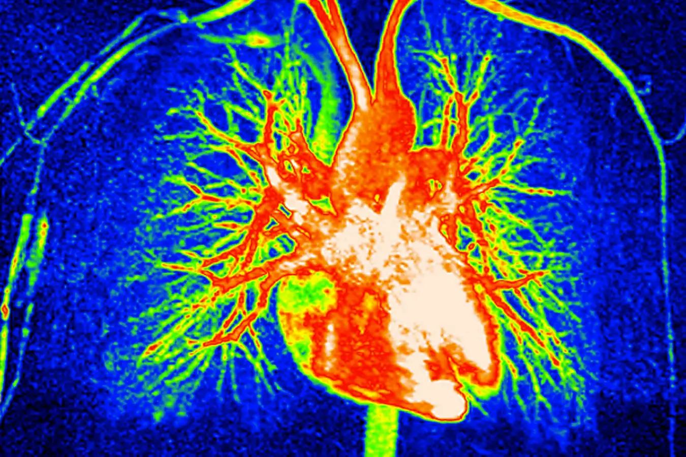 An image of a heart. The formation of liquid blobs called coacervates causes hearts transplants to fail 
