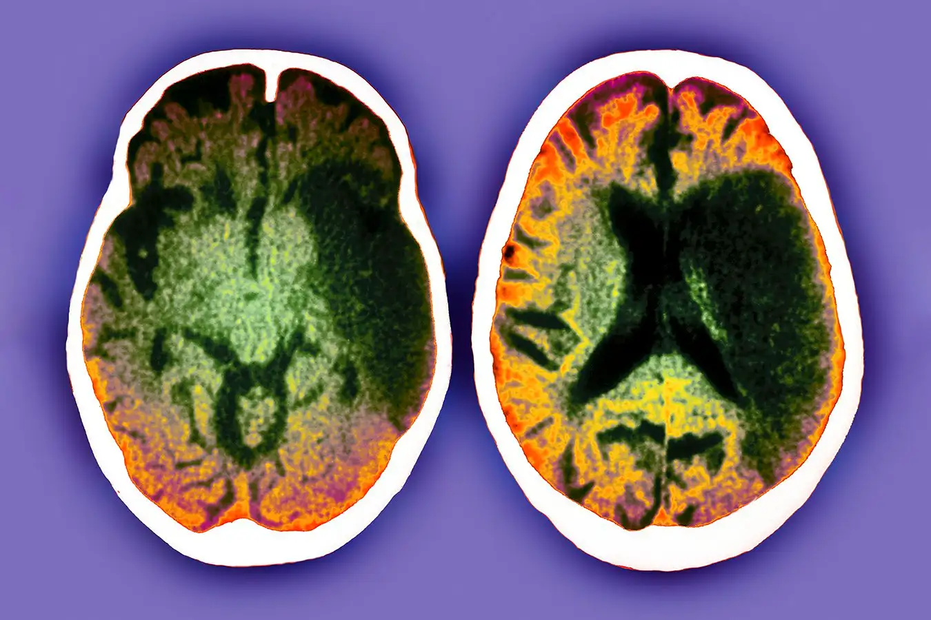 A brain scan showing the effects of a stroke