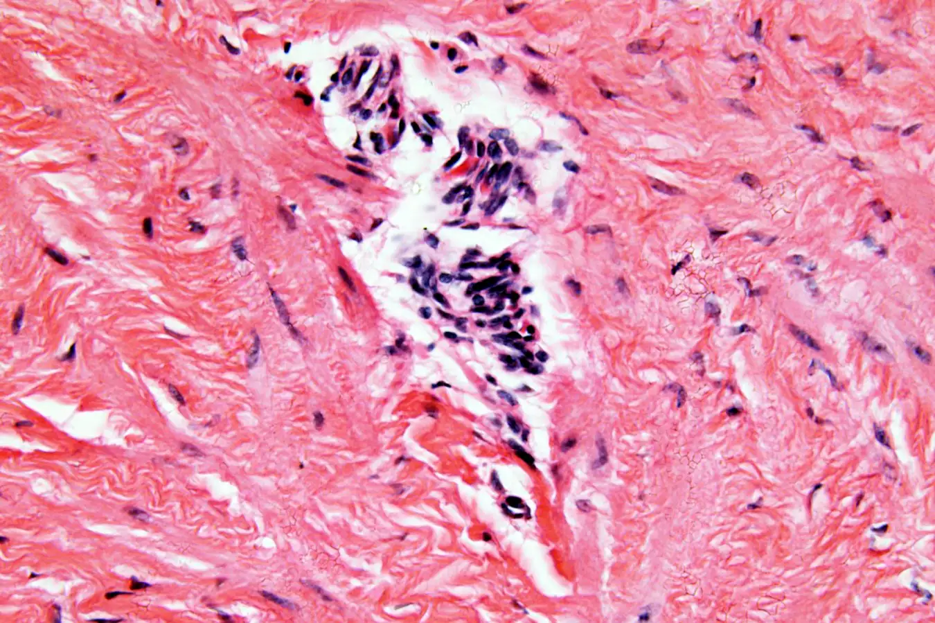 Light micrograph of a section through an ovary showing cysts caused by endometriosis