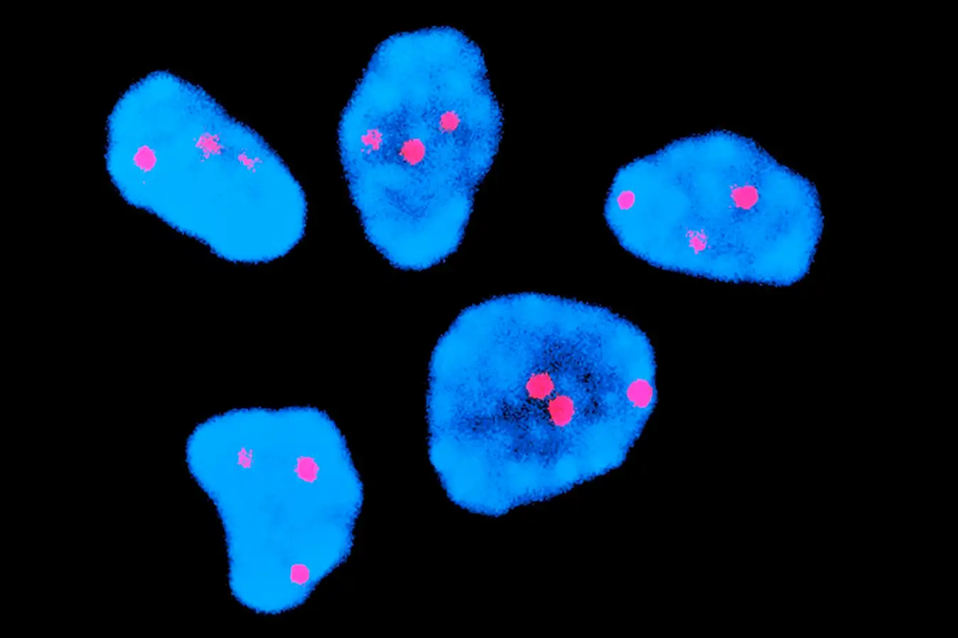 Fluorescence in situ hybridisation (FISH) micrograph of Down's syndrome chromosomes (red) in a foetus' cell nuclei (blue). The FISH technique enables individual chromosomes within the nuclei to be tagged with a fluorescent dye. Here, three copies of chromosome 21 are seen in each nucleus, the cause of Down's syndrome. In a healthy human, each nucleus contains only two copies of chromosome 21. Chromosomes are the parts of a nucleus responsible for carrying the genetic code. Down's syndrome is a genetic disease which causes mental retardation and typically flattened features. It affects around 1 in every 650 babies.
