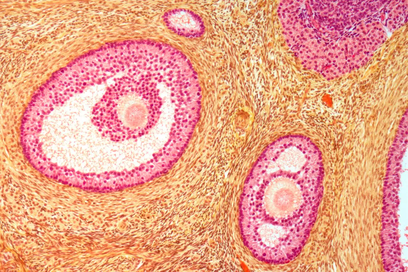 Light micrograph of a section through follicles in an ovary. The immature eggs (orange) are surrounded by a fluid-filled cavities (light pink) and granulosa cells (dark pink), which provide immature eggs with nutrients and hormones